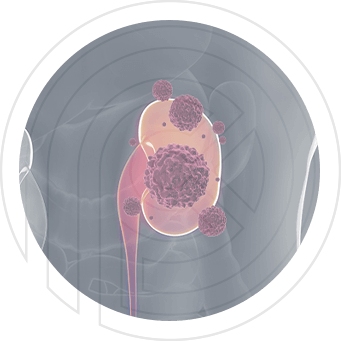 Imagem Câncer de Rim
